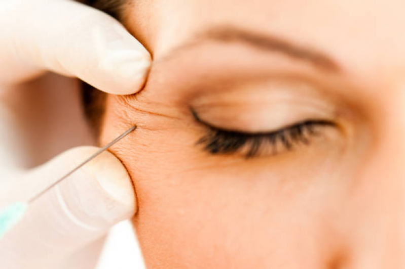 Botox Facial Agendar Serra da Cantareira - Botox para Testa